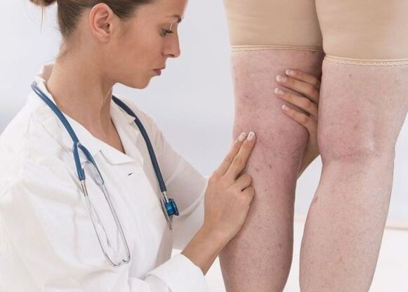 Diagnosticul venelor varicoase